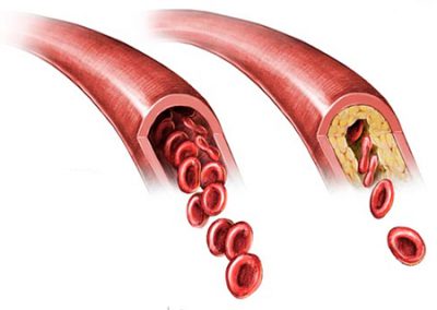 Атеросклероз сосудов: что это такое, болезнь артерий и кто лечит