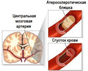 Источник кровоизлияния в мозг
