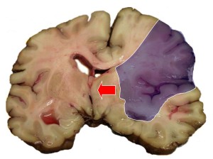 Зона отмирания участка головного мозга