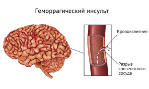 Кровоизлияние в мозг в результате удара