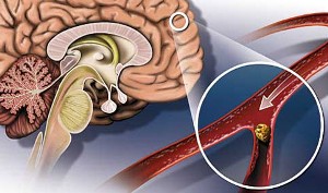 Атеросклероз сосудов головного мозга как причина инсульт-патологии
