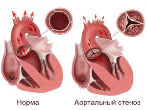 Сужение аорты и сердечных клапанов