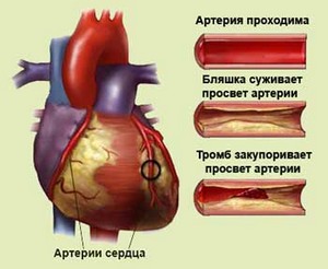 ишемической болезни сердца
