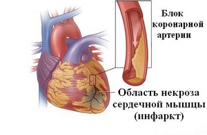 Развитие инфаркта