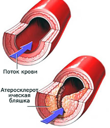 Атеросклеротические бляшки